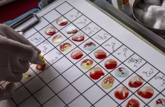 Η μεγαλύτερη παγκοσμίως δοκιμή ενός τεστ αίματος για ανίχνευση 50 ειδών καρκίνου