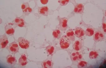 Φόβοι από νέο στέλεχος γονόρροιας: Για «μείζονα παγκόσμια απειλή» μιλάνε γιατροί 