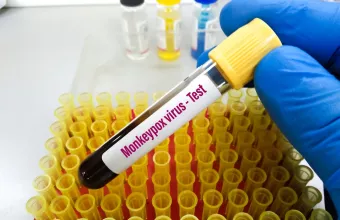 Ευλογιά των πιθήκων: Στα 20 συνολικά τα κρούσματα στην Ελλάδα – Η ανακοίνωση του ΕΟΔΥ