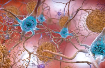 Αλτσχάιμερ