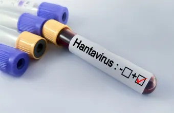 Hantavirus