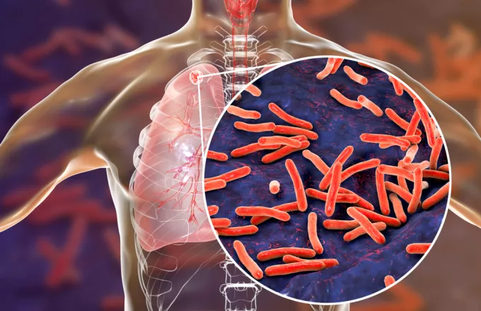 Για την απειλή της φυματίωσης προειδοποιεί η Ελληνική Πνευμονολογική Εταιρία