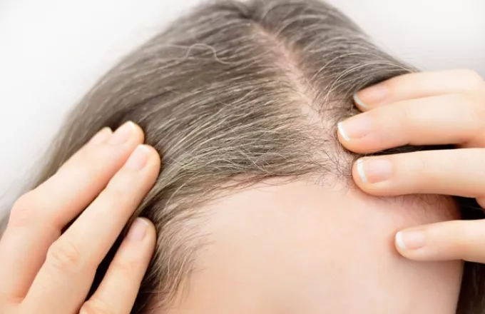 Άγχος: Επιστήμονες επιβεβαιώνουν πως ασπρίζουν απότομα τα μαλλιά και αποκαλύπτουν την αιτία
