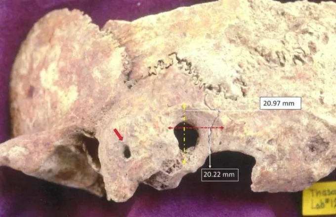Σημαντική ανακάλυψη στη Θάσο: Βρέθηκε κρανίο που είχε χειρουργηθεί τον 5ο -7ο αιώνα μ.Χ.