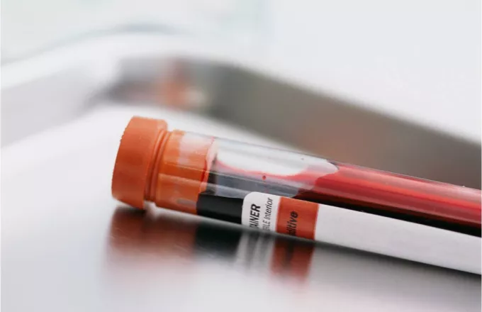 Διαθέσιμο στις ΗΠΑ το τεστ αίματος για την διάγνωση του Συνδρόμου Down