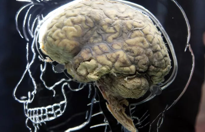 Το σχήμα του ανθρώπινου εγκεφάλου εξελίχθηκε στο πέρασμα 200.000 ετών 