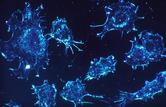 Υπάρχουν τρεις διαφορετικοί εξελικτικοί τύποι καρκίνου του νεφρού