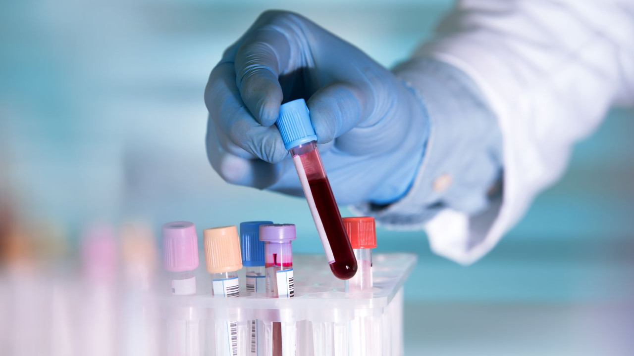 Βρετανία: «Μεγάλες υποσχέσεις» αφήνει δοκιμή τεστ αίματος που ανιχνεύει 50 τύπους καρκίνου