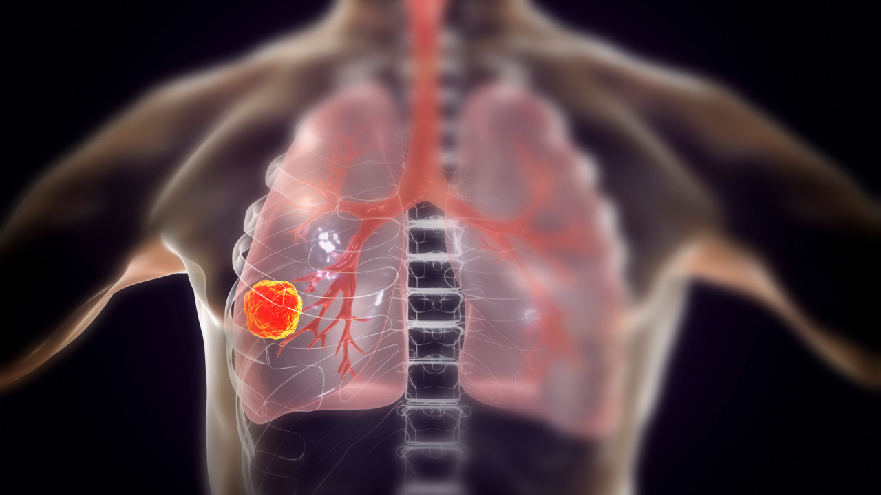 Οσιμερτινίμπη: Ποιο είναι το φάρμακο που χαρίζει ελπίδες κατά του μη μικροκυτταρικού καρκίνου του πνεύμονα