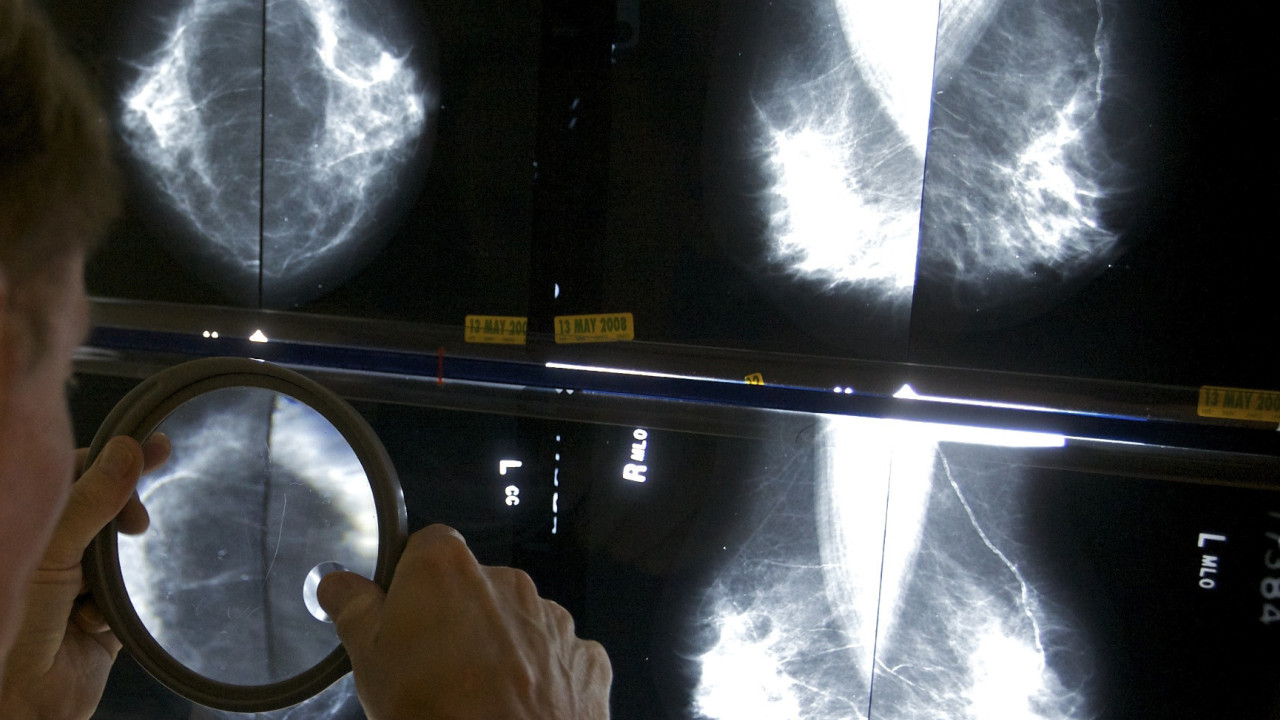 Έρευνα: Η χρήση τεχνητής νοημοσύνης στον προσυμπτωματικό έλεγχο του καρκίνου του μαστού είναι τόσο «ασφαλής» όσο δύο ακτινολόγοι