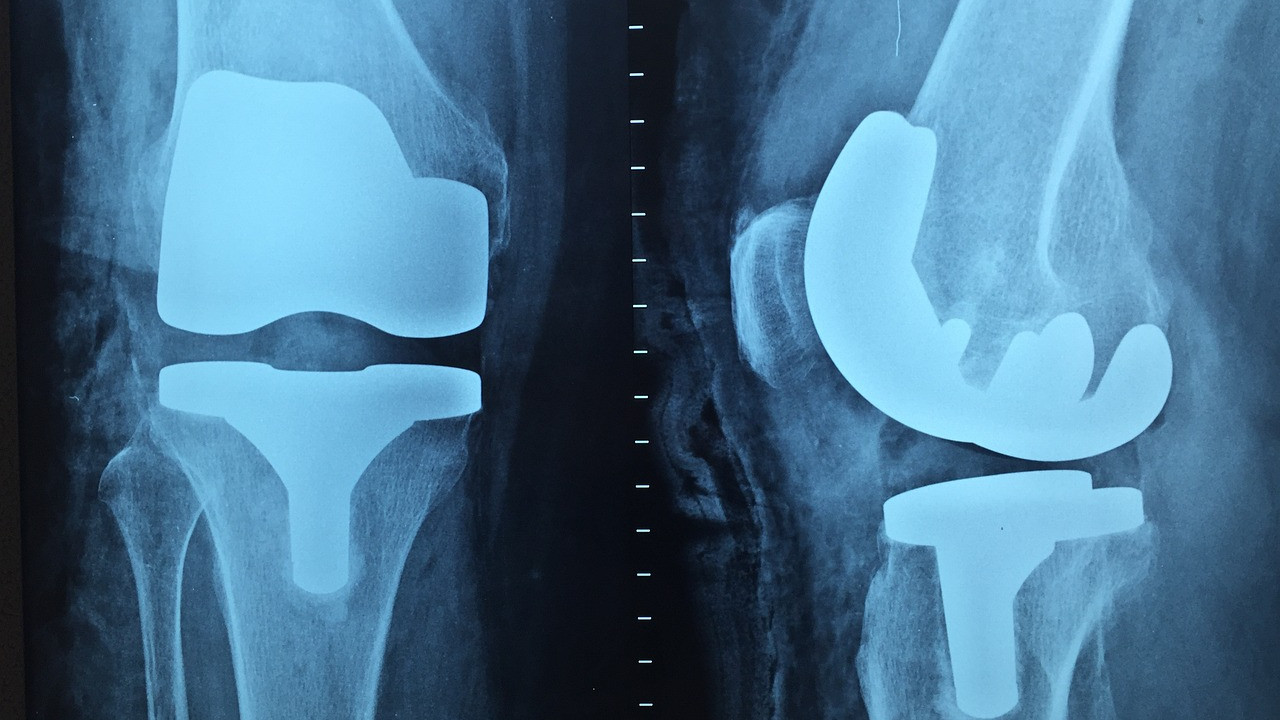 Αναγεννητική ορδοπαιδική: Βιολογική αντικατάσταση γόνατος