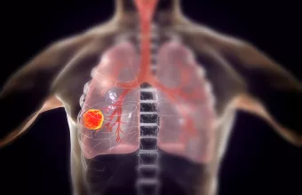 Lung Cancer 