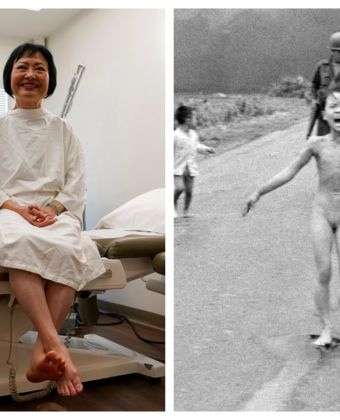 «Κορίτσι Ναπάλμ»: Tελευταία θεραπεία, 50 χρόνια μετά 