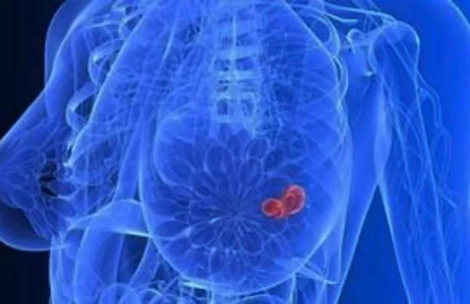 Εξέταση θα εντοπίζει τον καρκίνο του μαστού 5 χρόνια πριν την εμφάνιση του