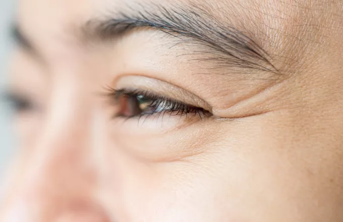Mαύροι κύκλοι, πόδι της χήνας και πώς θα βελτιώσεις την περιοχή των ματιών σου