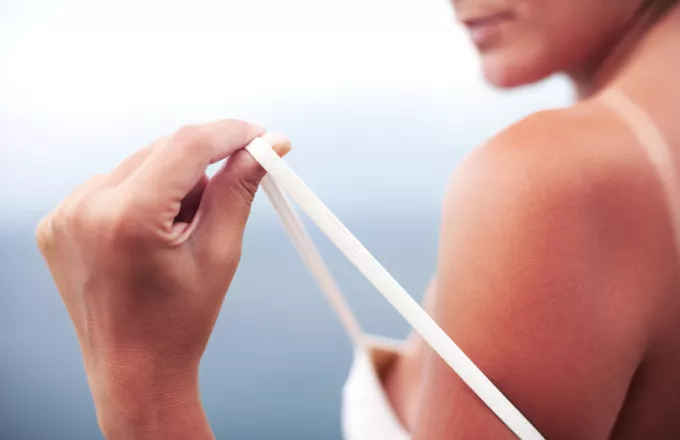 Πώς να φροντίσεις το δέρμα σου όταν ξεφλουδίζει από κάψιμο στον ήλιο