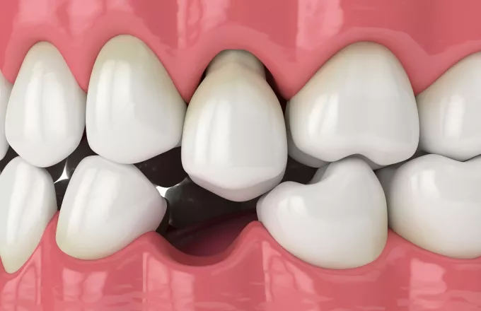 Έρευνα-ΗΠΑ: Η απώλεια δοντιών σχετίζεται με αυξημένο κίνδυνο για άνοια