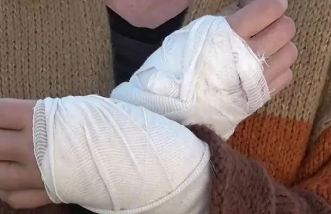 Γυναίκα δέχθηκε επίθεση από πιτ μπουλ στα Γλυκά Νερά - «Τα χέρια μου αχρηστεύτηκαν»