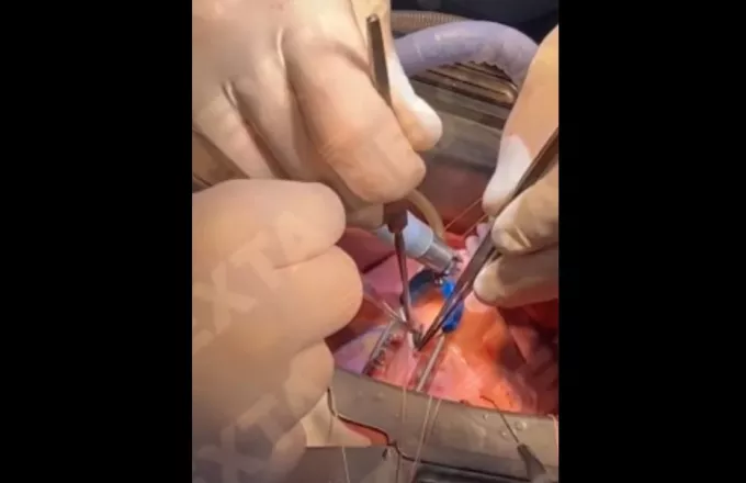 Χειρουργοί στο νοσοκομείο του Κιέβου αφαιρούν σφαίρα από καρδιά στρατιώτη -Δείτε το βίντεο