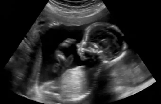 Υπερδιπλάσια πιθανότητα έκτρωσης για κοπέλες με οικογενειακό «ιστορικό»