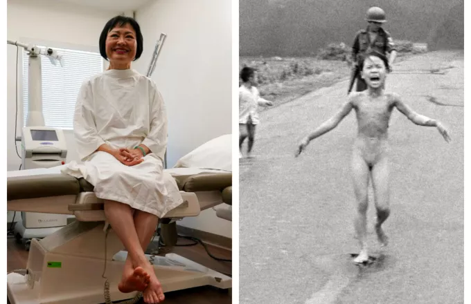 «Κορίτσι Ναπάλμ»: Tελευταία θεραπεία, 50 χρόνια μετά 