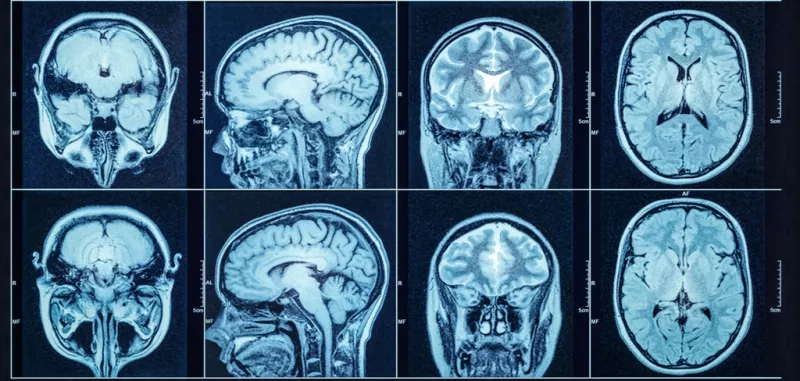 Brain Tumor