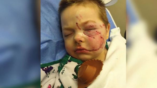 ΗΠΑ: 5χρονος δέχτηκε επίθεση από τον σκύλο του -Του έσκισε το μισό πρόσωπο και δε μπορεί πια να χαμογελάσει